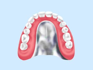 金属床義歯（自費診療）
