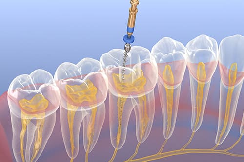 歯を残し見た目と機能を回復する根管治療とは？