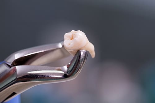 抜けた歯の放置はさまざまなリスクを引き起こします