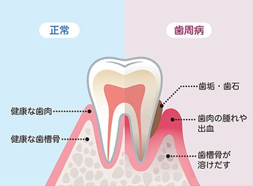 歯周病は歯を失うリスクのある病気です