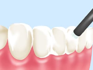 フッ素塗布で歯質強化