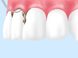 スケーリングで歯石・歯垢（プラーク）を徹底除